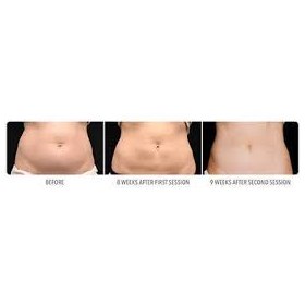 Evolution MedSpa Boston: Fat reduction by mean of Coolsculpting treatment